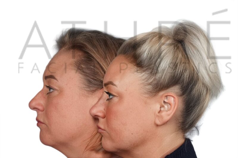 Before and after female primary ultrasonic rhinoplasty with refined nasal contour and feminine tip definition by Dr. Raghu Athré.