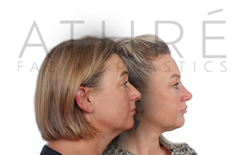 Before and after female primary rhinoplasty with smoother nasal profile and subtle feminine tip refinement by Dr. Raghu Athré.