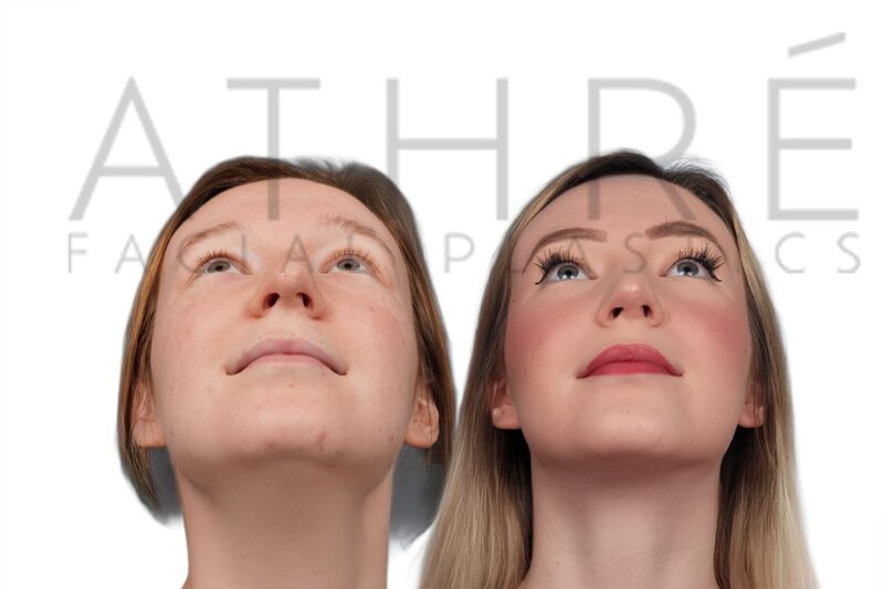Before and after female primary ultrasonic rhinoplasty with enhanced tip definition and refined feminine nasal contour by Dr. Raghu Athré.
