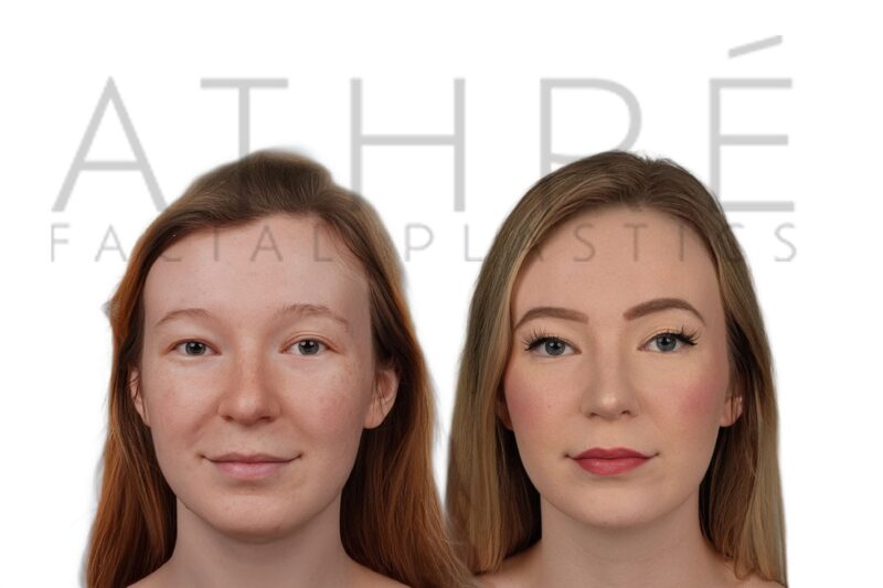 Before and after female primary rhinoplasty showing refined nasal tip and smoother feminine bridge contour by Dr. Raghu Athré.
