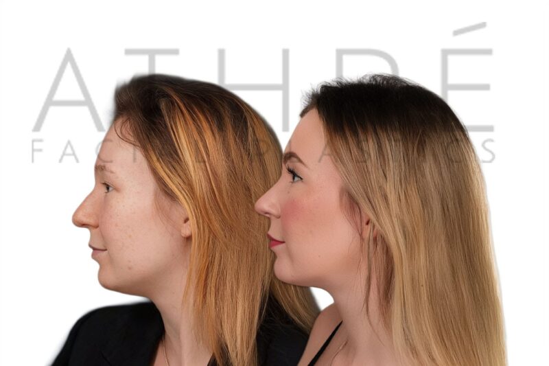 Before and after female primary ultrasonic rhinoplasty with refined feminine profile and smoother nasal contour by Dr. Raghu Athré.