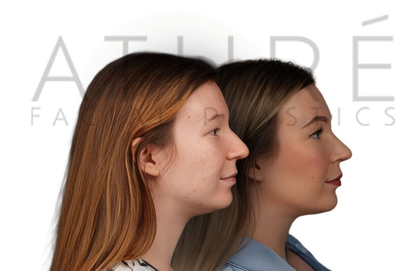 Before and after female primary rhinoplasty with smoother nasal bridge and feminine tip refinement by Dr. Raghu Athré.
