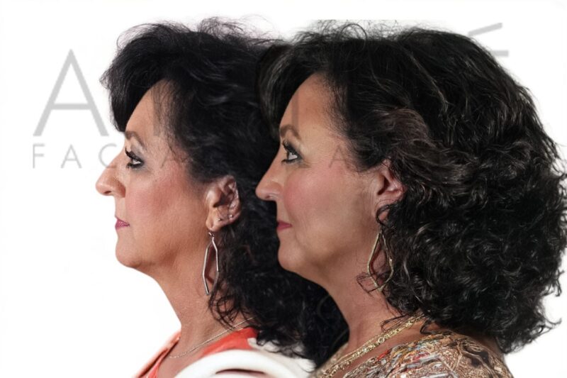 Before and after female primary rhinoplasty showing refined nasal contour and subtle tip elevation by Dr. Raghu Athré.