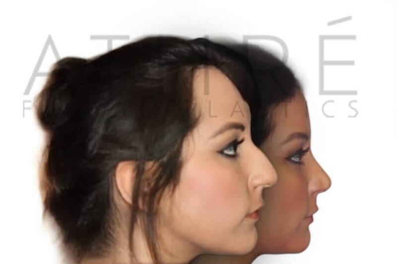 Before and after female primary ultrasonic rhinoplasty with smoother nasal bridge and feminine tip refinement by Dr. Raghu Athré.