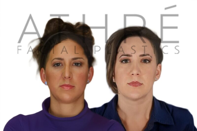 Before and after female primary rhinoplasty with refined feminine profile and enhanced tip definition by Dr. Raghu Athré.