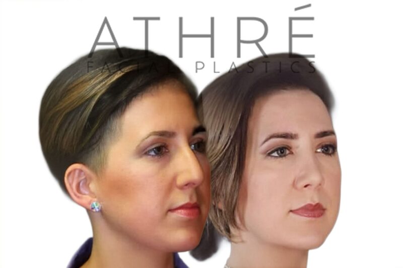 Before and after female primary ultrasonic rhinoplasty with feminine profile refinement and smoother nasal contour by Dr. Raghu Athré.