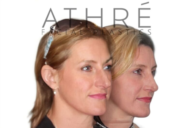 Before and after female primary rhinoplasty with shortened nasal profile and refined tip contour by Dr. Raghu Athré.
