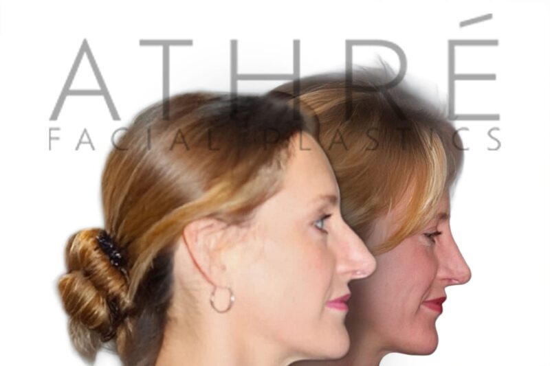 Before and after female primary ultrasonic rhinoplasty with nasal shortening and refined feminine profile by Dr. Raghu Athré.