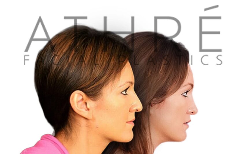 Before and after side profile of female patient following primary rhinoplasty with dorsal hump reduction and tip refinement by Dr. Raghu Athré