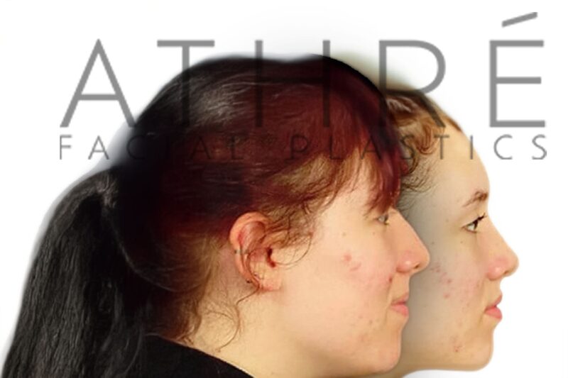 Before and after female primary rhinoplasty showing smoother nasal bridge and refined nasal tip by Dr. Raghu Athré.