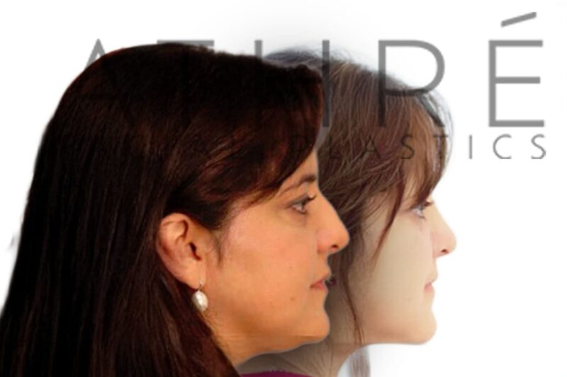 Female patient before and after ultrasonic rhinoplasty with improved nasal profile and subtle tip rotation by Dr. Raghu Athré.
