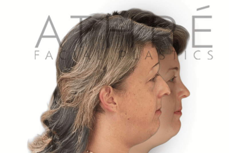 Before and after female primary rhinoplasty showing dorsal hump reduction, refined nasal tip, and shortened nose by Dr. Raghu Athré