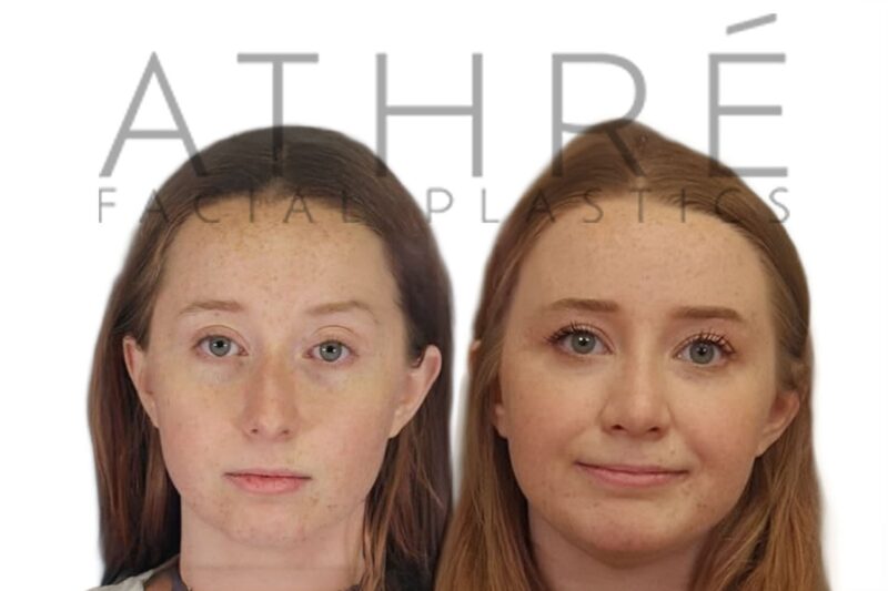 Before and after female primary rhinoplasty with refined nasal profile and tip definition by Dr. Raghu Athré.