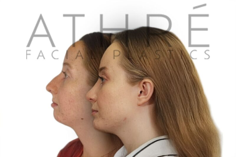 Before and after female primary ultrasonic rhinoplasty with enhanced tip contour and dorsal hump reduction by Dr. Raghu Athré.