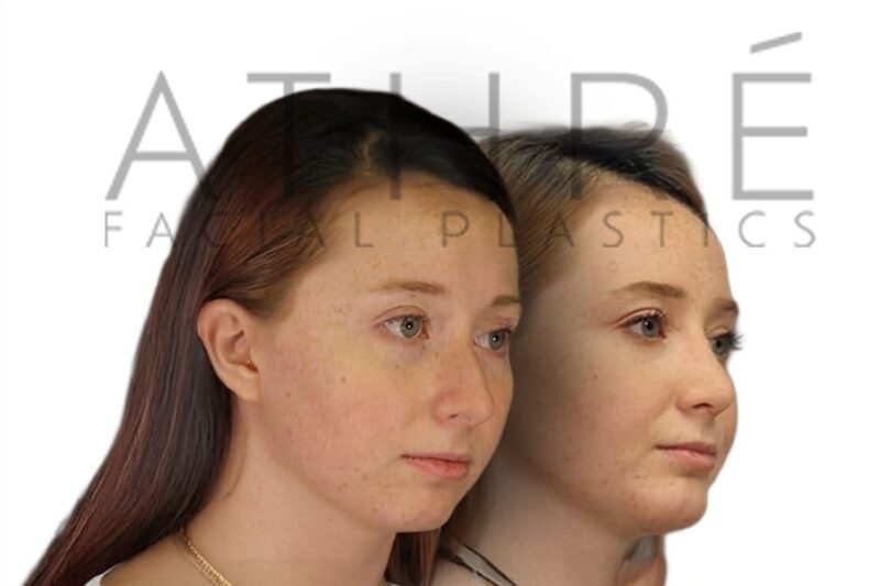 Before and after female primary rhinoplasty showing refined nasal tip and smoother bridge contour by Dr. Raghu Athré.