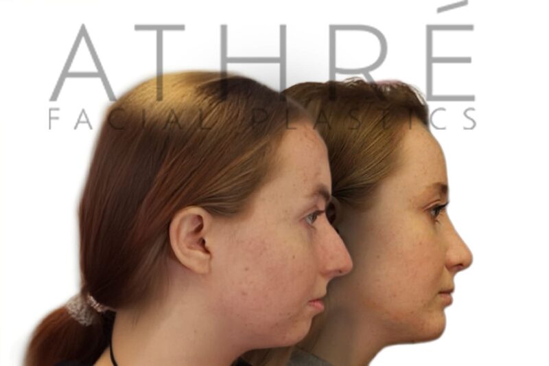 Before and after female primary ultrasonic rhinoplasty with smoother nasal profile and refined tip definition by Dr. Raghu Athré.