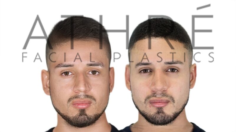 Before and after male primary ultrasonic rhinoplasty showing refined nasal contour and tip refinement by Dr. Raghu Athré.