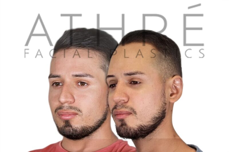 Before and after male primary rhinoplasty with enhanced tip definition and balanced nasal profile by Dr. Raghu Athré.