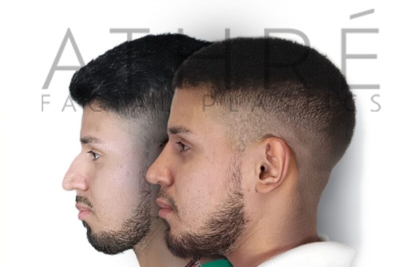 Before and after male primary ultrasonic rhinoplasty with refined tip structure and smoother nasal bridge by Dr. Raghu Athré
