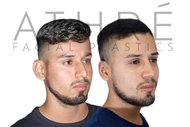 Before and after male primary rhinoplasty showing smoother nasal profile and improved tip definition by Dr. Raghu Athré.