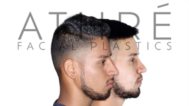 Before and after male primary ultrasonic rhinoplasty with dorsal hump reduction and refined tip contour by Dr. Raghu Athré.