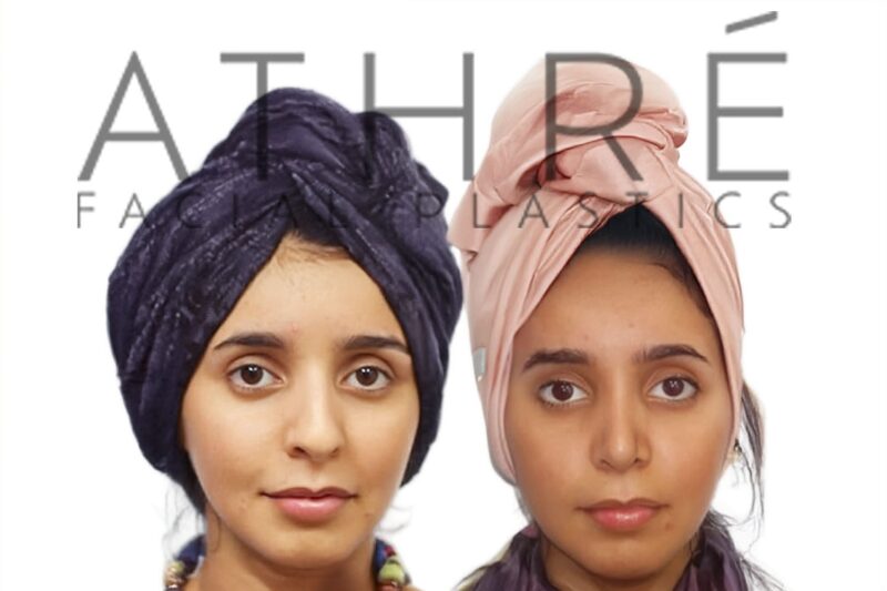 Before and after side profile of female patient following primary rhinoplasty with dorsal hump reduction and feminine profile refinement by Dr. Raghu Athré