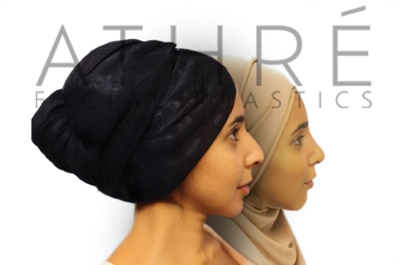Before and after female primary ultrasonic rhinoplasty with dorsal hump reduction and feminine profile refinement by Dr. Raghu Athré