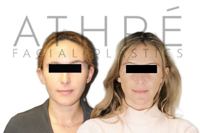 Before and after female primary rhinoplasty with refined nasal tip and reduced dorsal hump by Dr. Raghu Athré.