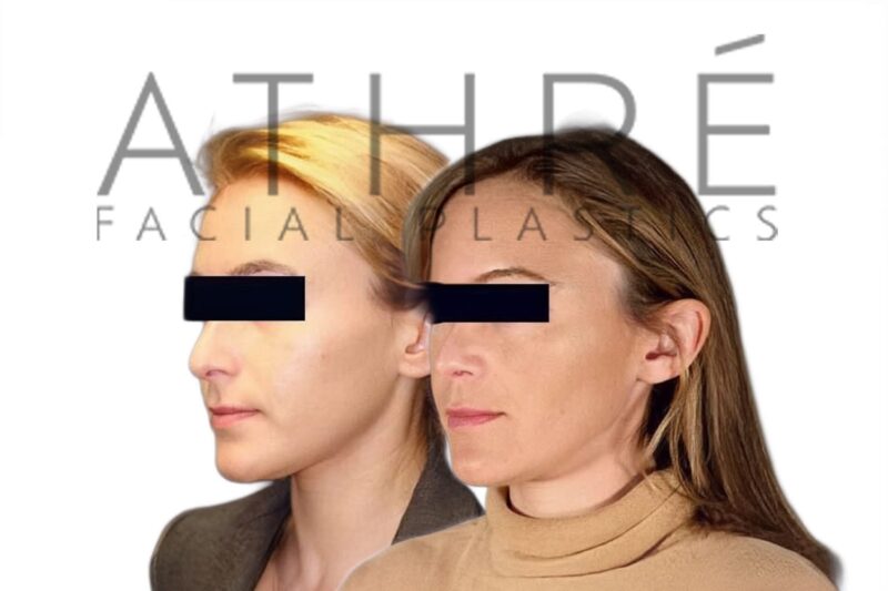 Before and after female primary ultrasonic rhinoplasty with enhanced tip definition and smoother nasal profile by Dr. Raghu Athré.