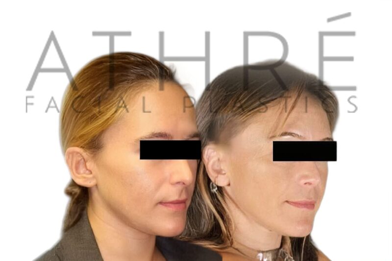 Before and after female primary rhinoplasty showing smoother nasal bridge and subtle tip refinement by Dr. Raghu Athré.