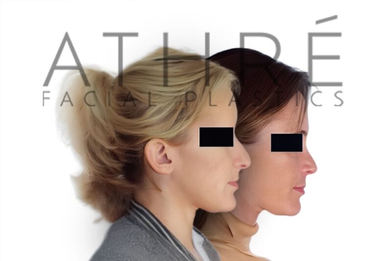 Before and after female primary ultrasonic rhinoplasty with dorsal hump reduction and refined tip contour by Dr. Raghu Athré.