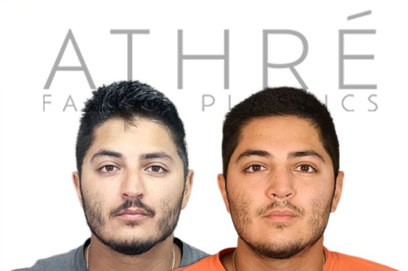 Before and after male primary rhinoplasty with refined tip structure and reduced dorsal hump by Dr. Raghu Athré.