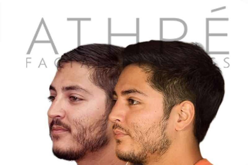Before and after male primary rhinoplasty showing smoother nasal profile and refined tip contour by Dr. Raghu Athré