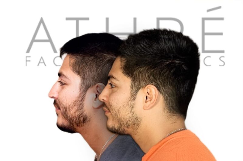 Before and after male primary rhinoplasty with dorsal hump reduction and improved tip definition by Dr. Raghu Athré