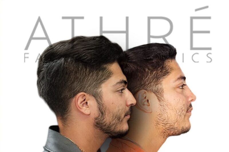 Before and after male primary rhinoplasty with refined tip contour and smoother nasal profile by Dr. Raghu Athré.