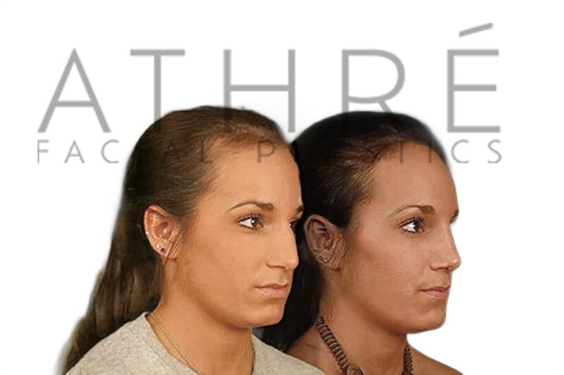 Before and after female primary rhinoplasty with dorsal hump reduction and subtle tip rotation by Dr. Raghu Athré.