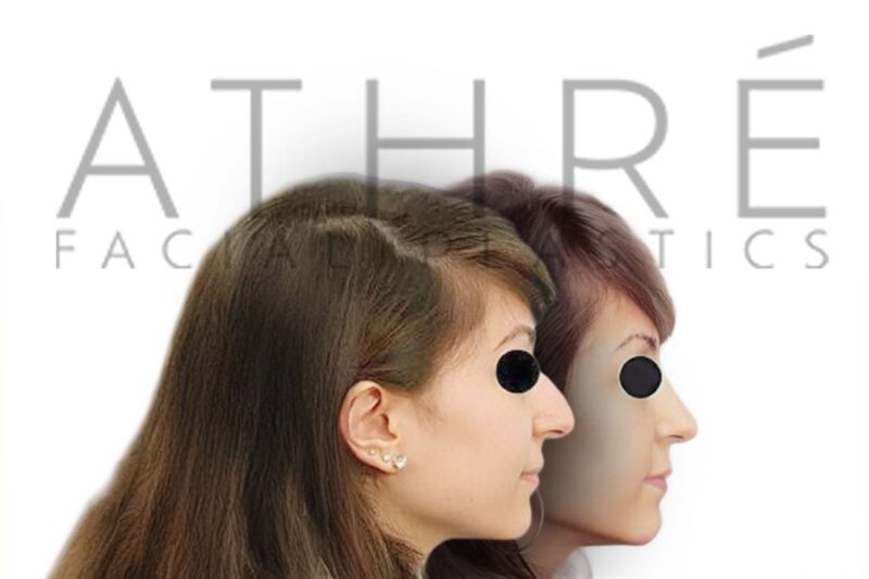 Before and after female primary rhinoplasty showing refined tip definition and smoother nasal profile by Dr. Raghu Athré.