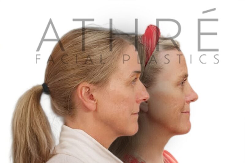 Before and after female primary rhinoplasty with dorsal hump reduction and refined nasal tip by Dr. Raghu Athré