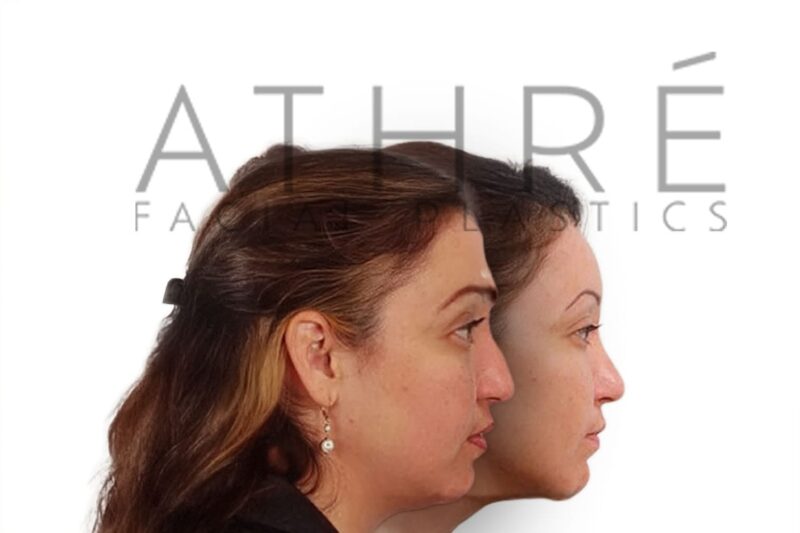 Before and after side profile of female patient following primary rhinoplasty with refined tip contour and dorsal hump reduction by Dr. Raghu Athré