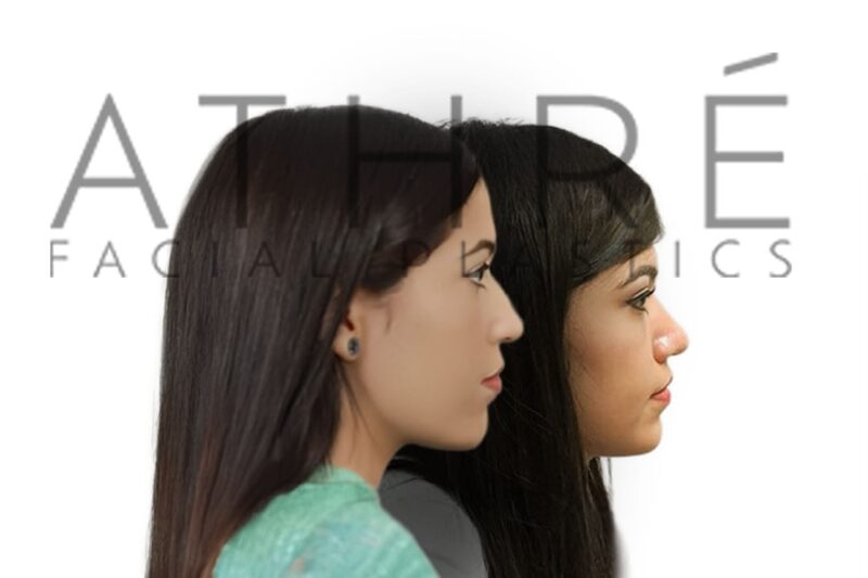 Before and after female patient undergoing primary rhinoplasty with dorsal hump reduction and enhanced tip definition by Dr. Raghu Athré
