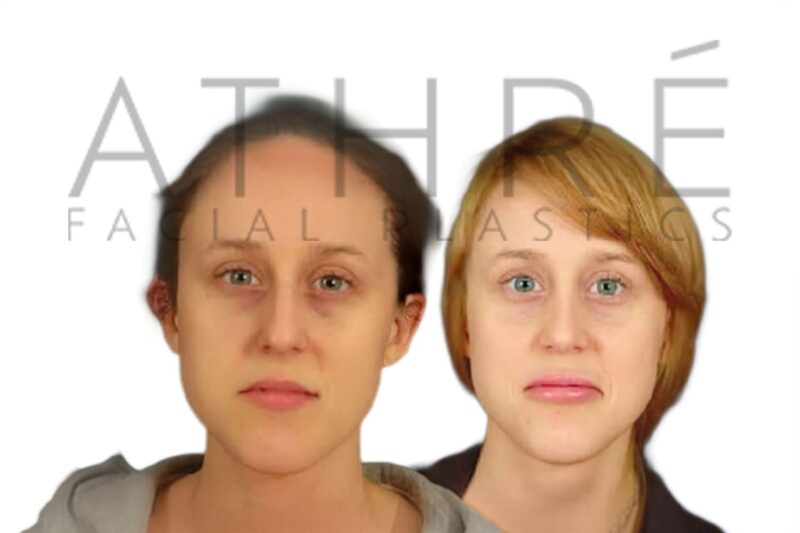 Before and after female primary rhinoplasty showing dorsal hump reduction and refined nasal tip contour by Dr. Raghu Athré