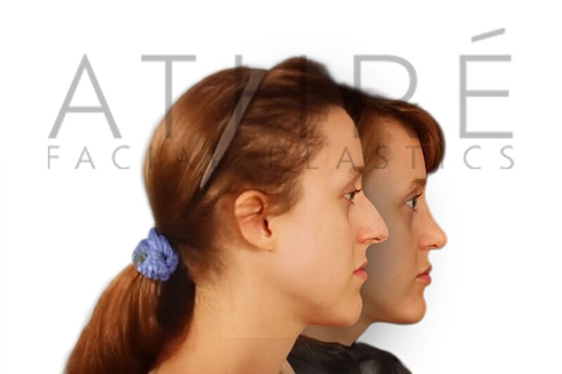 Before and after side profile of female patient following primary rhinoplasty with smoother nasal bridge and tip refinement by Dr. Raghu Athré