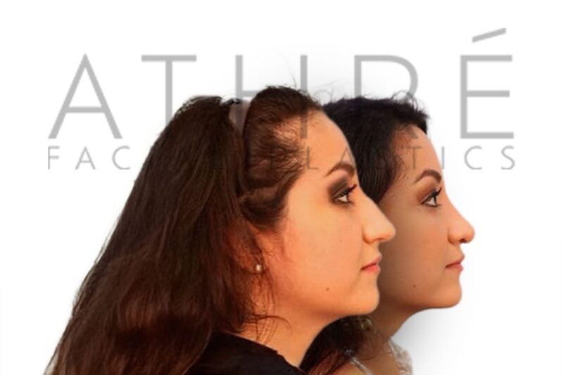 Before and after female primary rhinoplasty with dorsal hump reduction and improved tip definition by Dr. Raghu Athré.