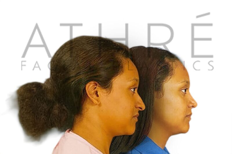 Before and after female rhinoplasty correcting hanging nasal tip and elongated nasal profile by Dr. Raghu Athré.