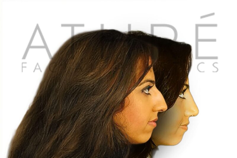 Before and after female rhinoplasty with dorsal hump reduction and enhanced tip refinement by Dr. Raghu Athré