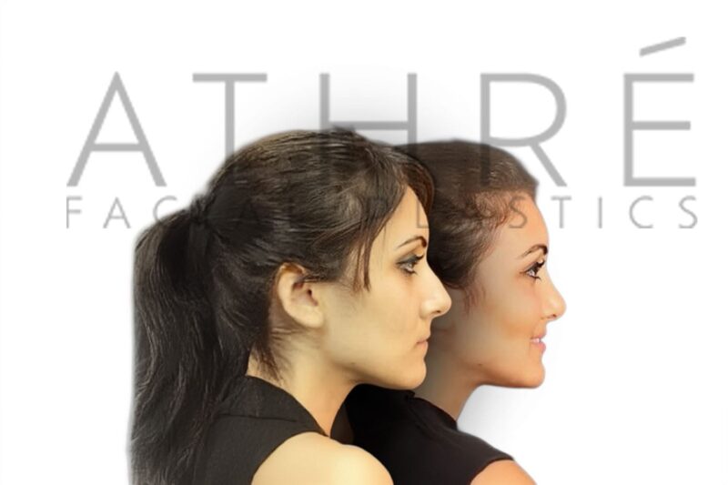 Before and after female rhinoplasty showing smoother nasal bridge and refined tip contour by Dr. Raghu Athré