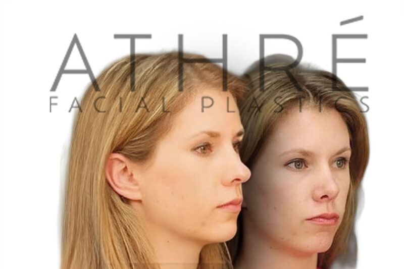 Before and after female rhinoplasty with tip deprojection and refined nasal tip contour by Dr. Raghu Athré