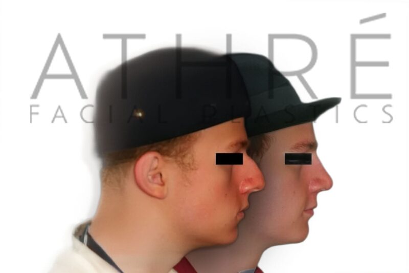 Before and after male rhinoplasty with dorsal hump reduction and refined nasal tip by Dr. Raghu Athré.