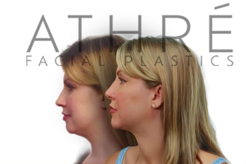 Before and after female rhinoplasty with refined nasal tip and reduced dorsal width by Dr. Raghu Athré.