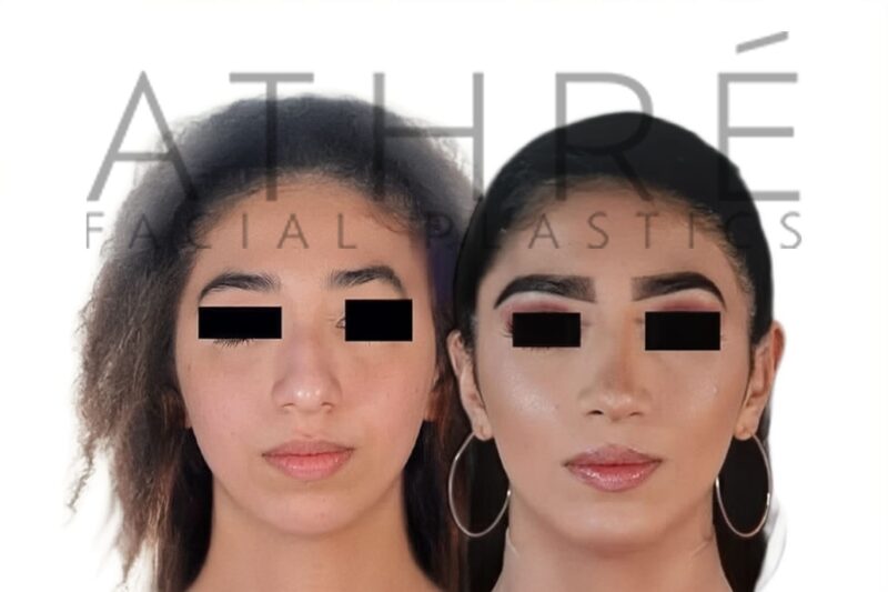 Before and after female ethnic rhinoplasty with refined nasal contour and dorsal hump reduction by Dr. Raghu Athré.